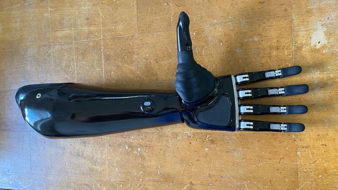 Фонд обеспечил жителя Приамурья современными бионическим протезом